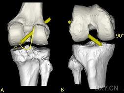 韧带重建视频,视频解析与要点梳理
